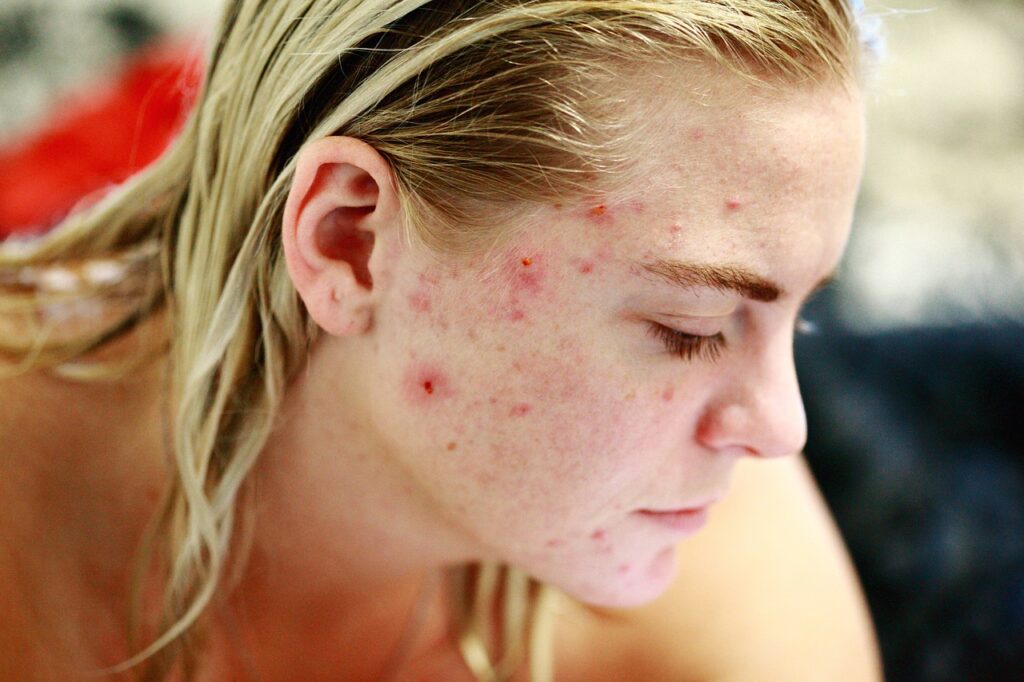 Akne Pickel Hautunreinheiten Schwere Akne Was können die Ursachen sein